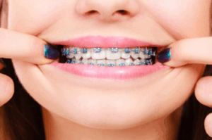 Patient pulling back her lips to reveal her braces
